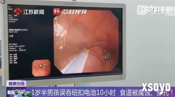 幼儿误吞电池10小时致终身残疾 医生提醒危害不可忽视